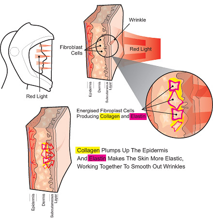 Fine-Light Red LED Light Therapy naturally stimulates the production of collagen and elastin giving you more youthful and beautiful skin. This anti-aging procedure helps your skin look and feel younger.
